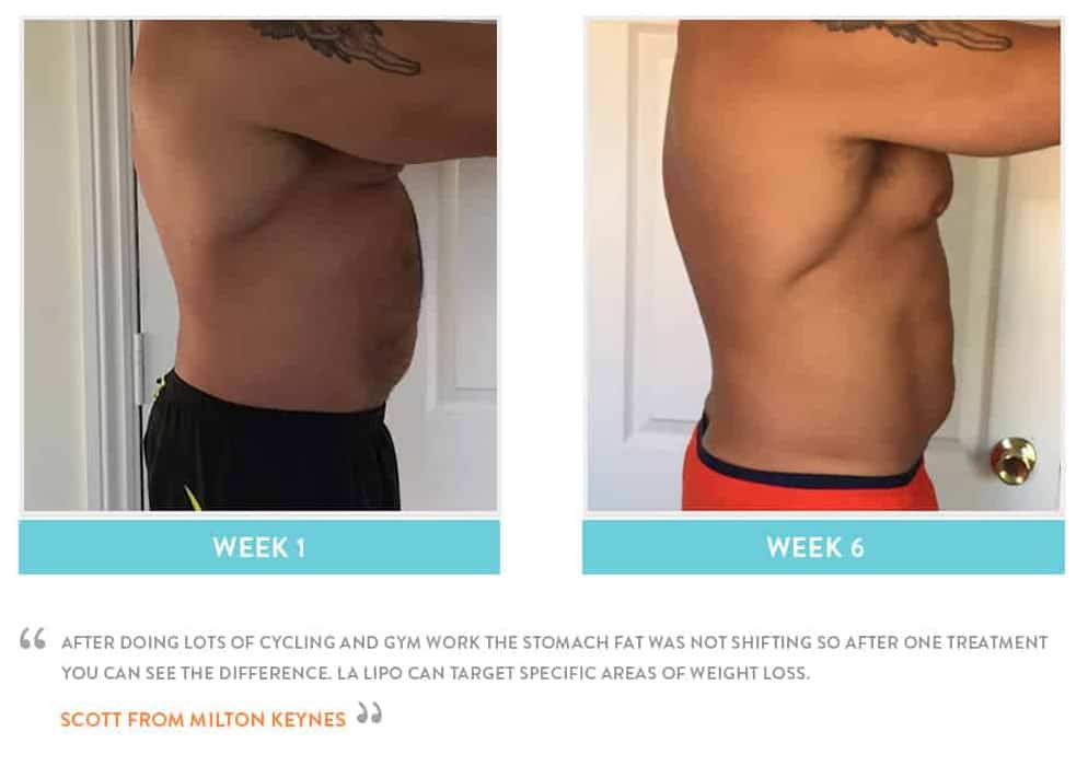 Before & After Stomach Fat Teddington