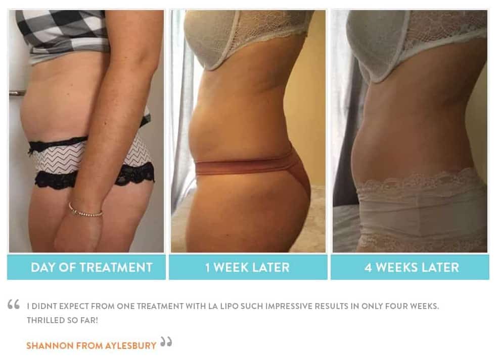 before, Cryolipolysis Teddington
