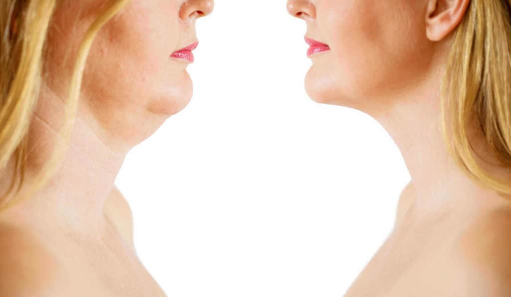 Double Chin treatment Teddington before and after results