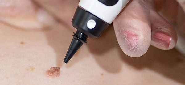 After Skin Tag Removal Teddington
