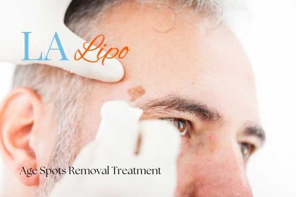 What Are the Most Effective Treatments for Age Spots Teddington?