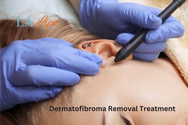 Dermatofibroma Removal Treatment Teddington