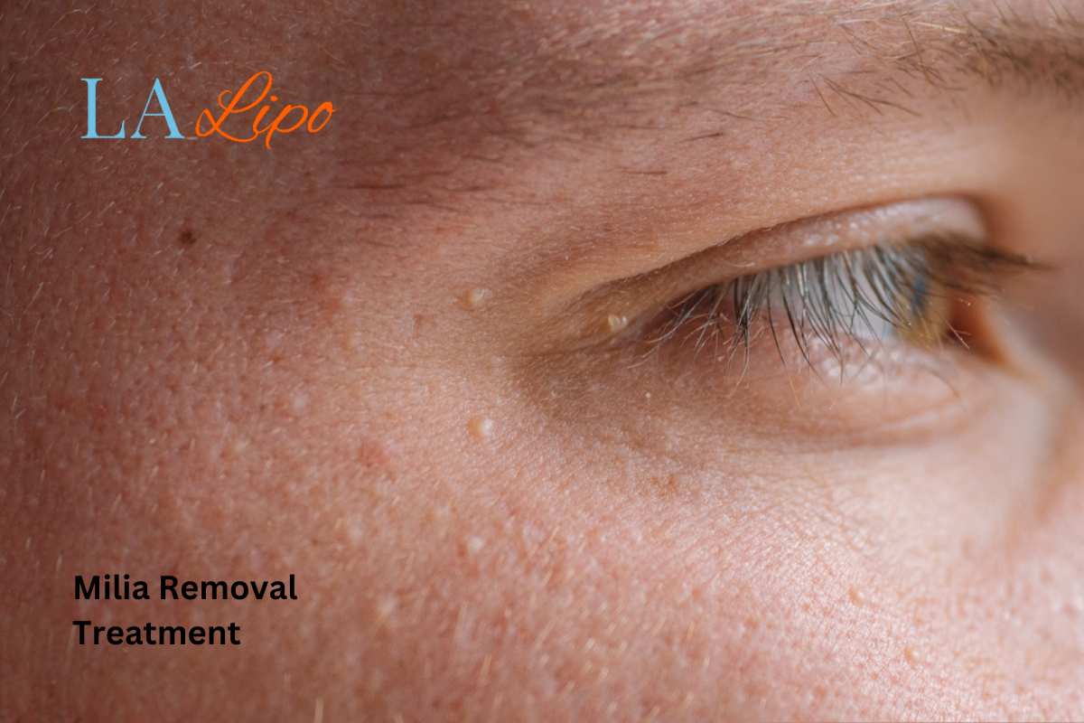 Cryopen Milia Removal: Is It the Easiest and Safest Option Teddington?