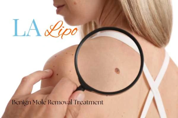 Why getting moles removed Teddington can boost your confidence!