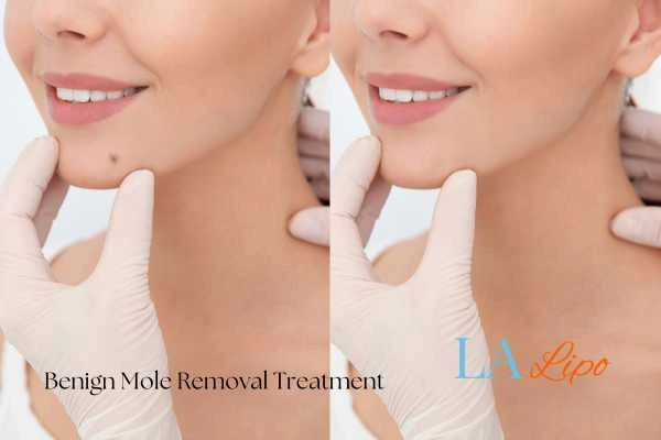 woman's before and after mole removal Teddington results