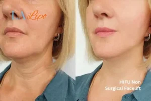 hi-fu for wrinkles Teddington before and after results