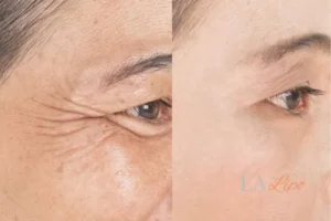 Before and after results of woman - HI-fu wrinkles reduction treatment Teddington
