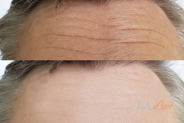results of HIFU Teddington on mans forehead to help reduce lines and wrinkles