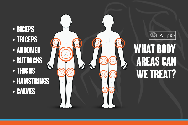 Graphic to show areas you can have LA-EMS Body Sculpting Teddington treatment.