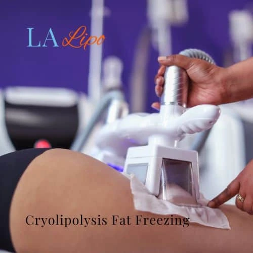 fat freezing - Cryolipolysis Teddington