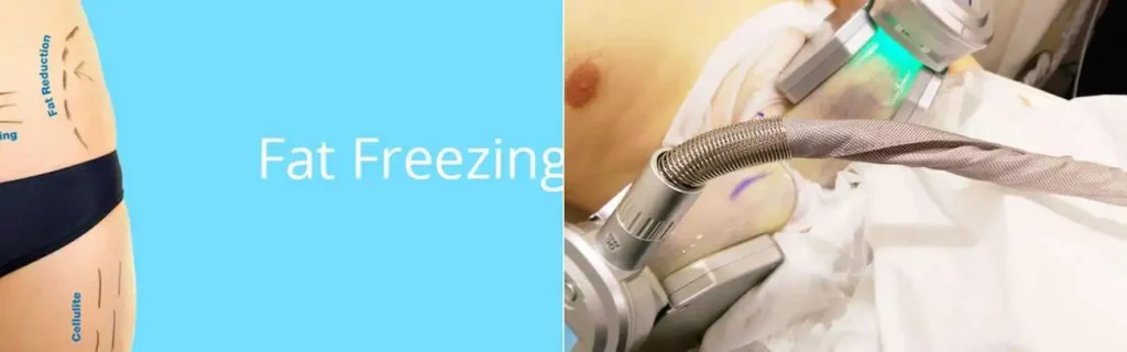 multi areas of a persons body having coolsculpting Teddington treatment