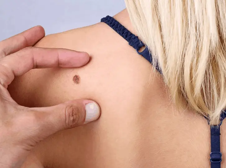 woman having mole removal Teddington consultation before treatment.