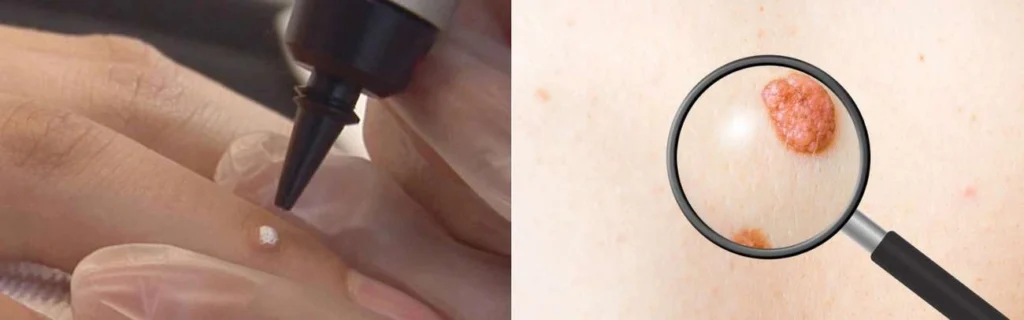 Person getting moles removed with cryopen Teddington