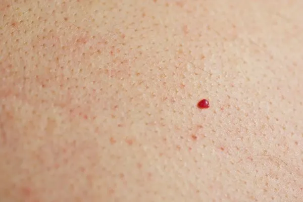 close up of a cherry angioma Teddington