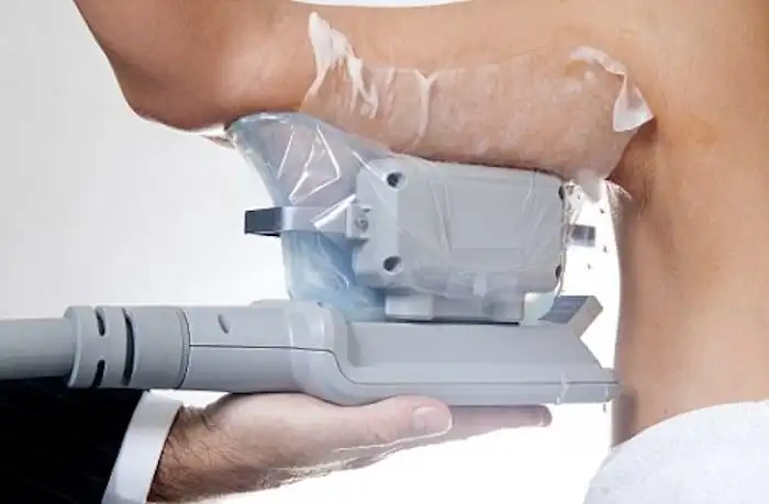 Picture of fat freezing Teddington on the upper arms.