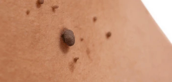 image of a skin tag Teddington
