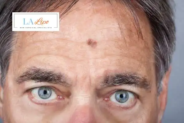 Solar Lentigo Removal Teddington image of man with mark on his forehead