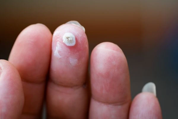 wart on person finger - cryotherapy to treat from LA LIPO Teddington