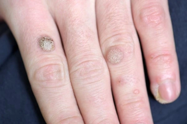 photo of warts on person hand - see wart removal Teddington from LA LIPO