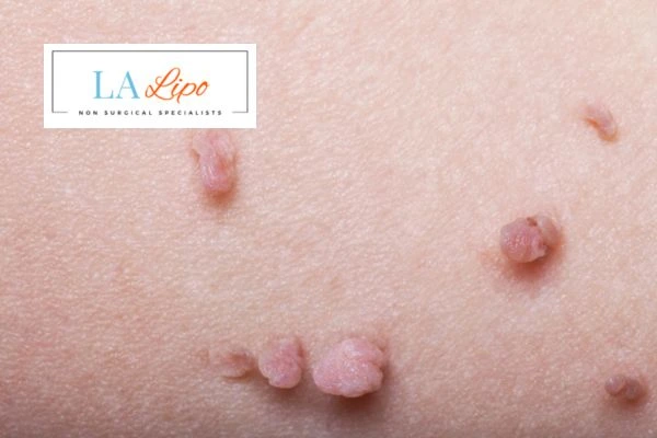 Does cryopen skin tag removal Teddington hurt? Find out now call our team today!