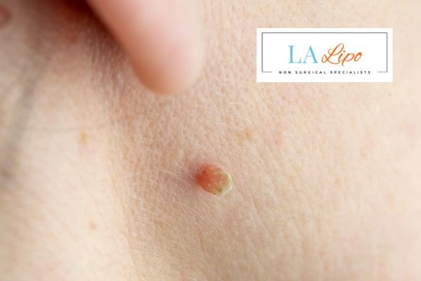 Book skin tag removal Teddington today speak to our team now!