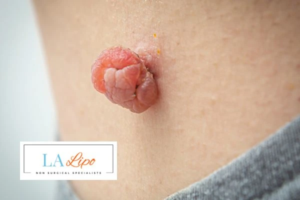 Interested in skin tag removal Teddington? Concerned about the pain? Find out more today!