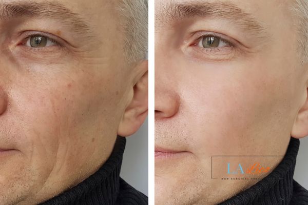 See the amazing results of Morpheus8 Treatment Teddington!