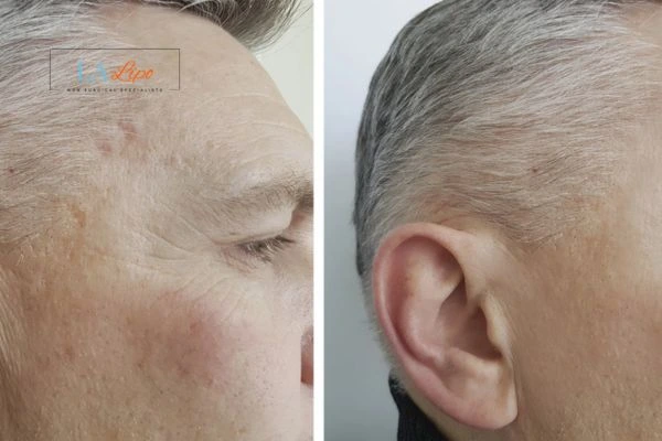Mens Before & After Morpheus 8 Results Teddington