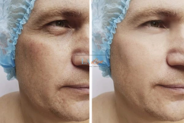 Before and after Morpheus 8 Results Teddington