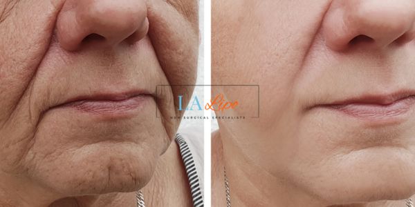 Older lady deeper wrinkle reduction - LA LIPO Morpheus 8 Results Teddington
