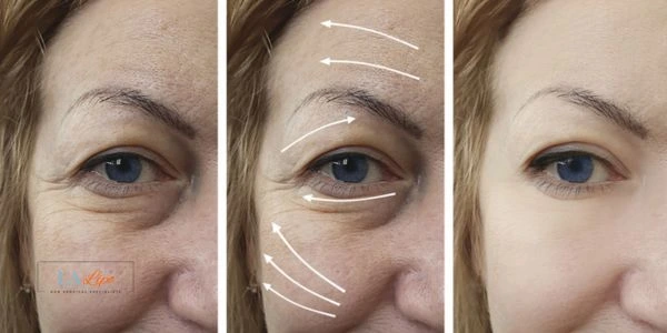 Amazing eye lift Morpheus 8 results Teddington