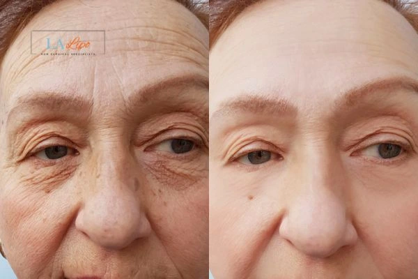 The powerful benefits of Morpheus8 Treatment Teddington - Call Our team today!