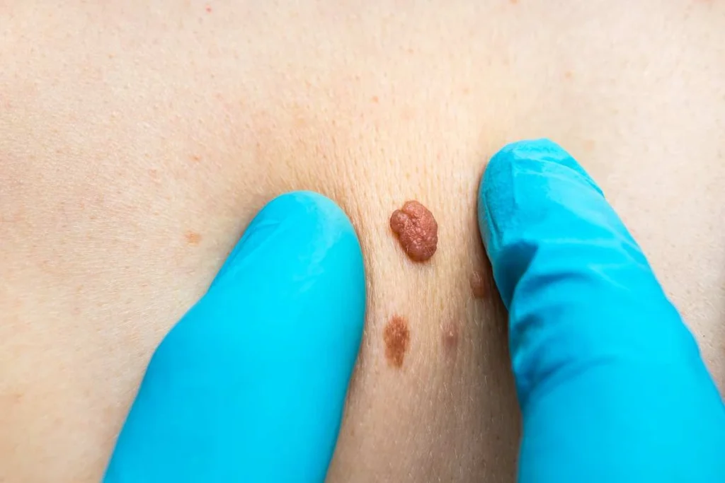 LA LIPO Cryopen Lesion Removal Prices Teddington