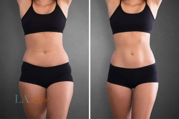before and after results of non-surgical treatment to help a woman's body image and mental health Teddington