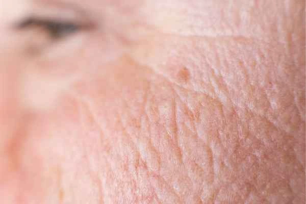 close up picture of a woman's face showing an age spot Teddington