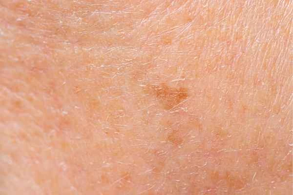 close up picture of age spots Teddington