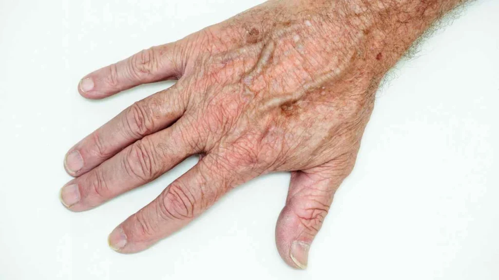 Male hand showing age spot Teddington