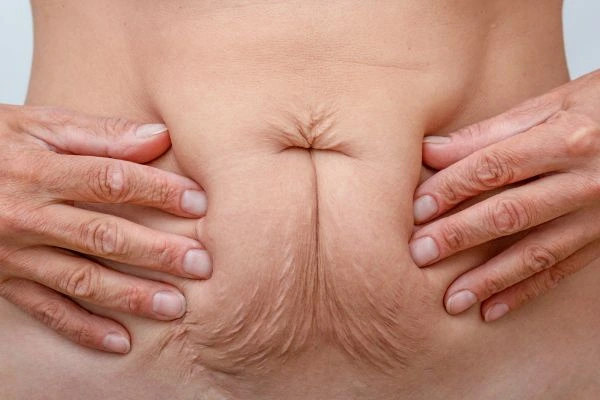 Image of a woman's stomach with loose skin - example of skin tightening Teddington options