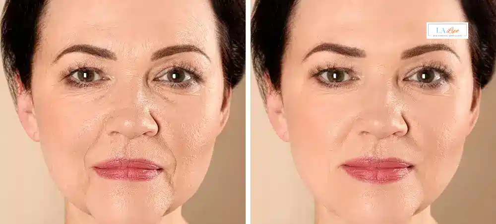 How Long Does It Take to See Results and How Long Do They Last Teddington?