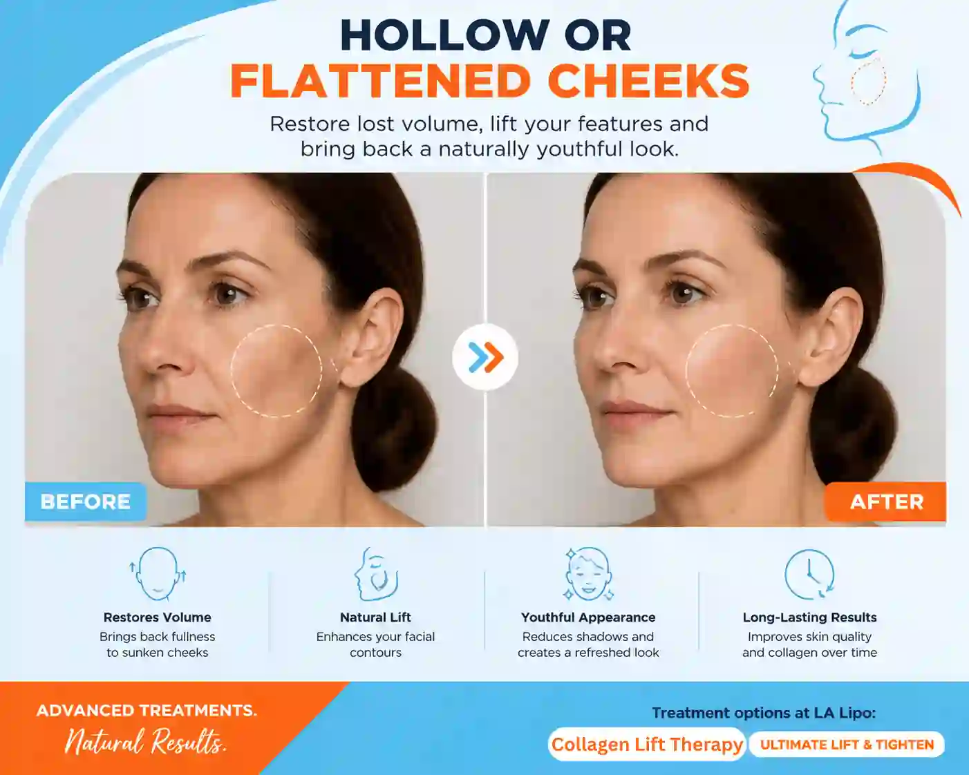 Sign #4: Hollow or Flattened Cheeks Teddington