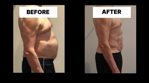 What Symptoms Can Diastasis Recti Cause in Men? Weak Core, Back Pain and Poor Posture Teddington